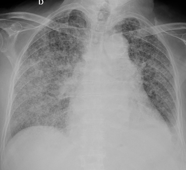 Una docena de alumnos de varios centros escolares afectados por un brote de tuberculosis