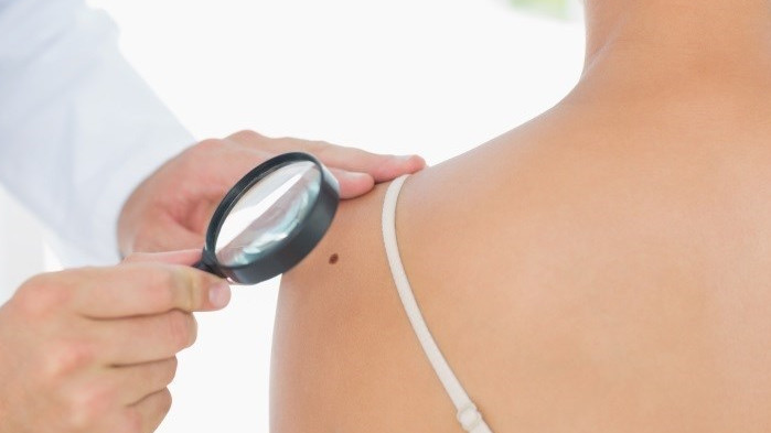 ​Las tasas de mortalidad por melanoma no bajarán hasta 2050